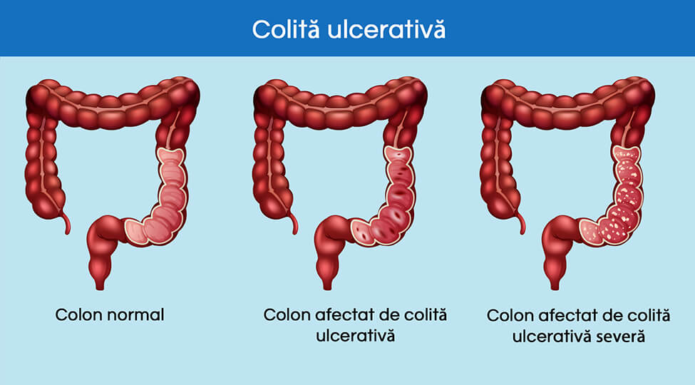 Colita ulcerativa – Simptome, cauze, dieta si tratament