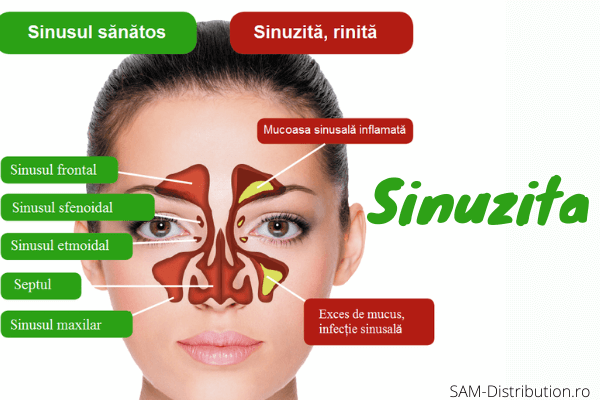 Sinuzita: tipuri, cauze, simptome, diagnostic, tratament | Bioclinica