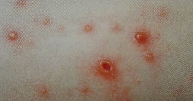 Totul despre varicela: Simptome, cauze, modalitati de ameliorare si prevenire