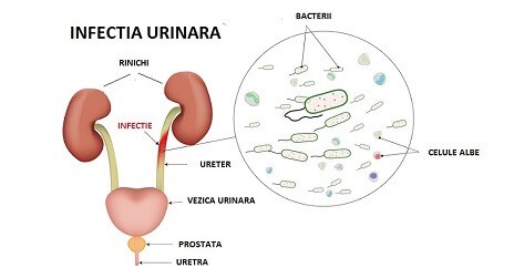 infectie urinara simptom