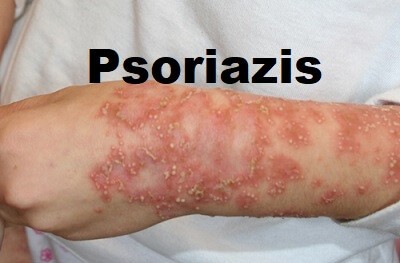 Psoriazis: Cauze, simptome si solutii de tratament 