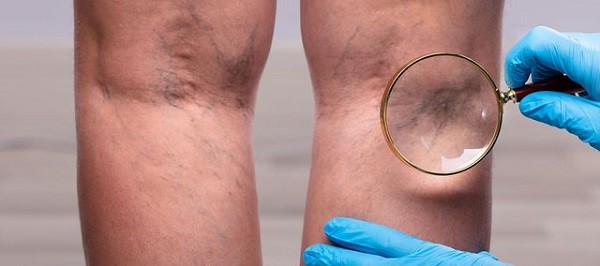Cum să identificați varicele pe fotografia picioarelor - Cum să identificați varicoza sau tromboza