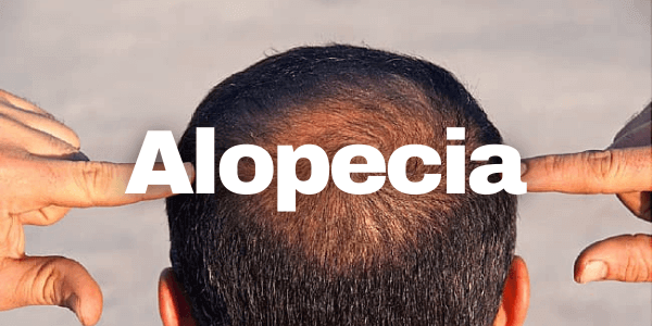 Alopecia (caderea parului): ce este? Cauze si tratament