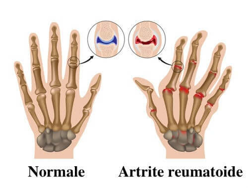 Artrita reumatoida: 7 sfaturi pentru ameliorarea acesteia