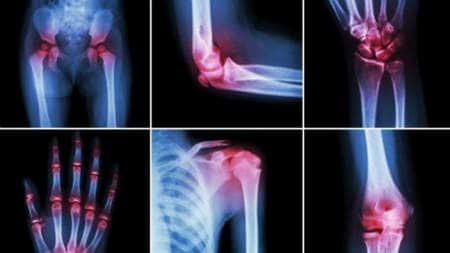 Durerile articulare – simptome, cauze si tratament