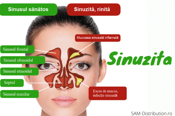 Totul despre sinuzita: simptome, cauze si tratament