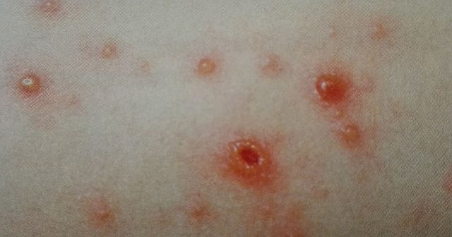 Varicela – Simptome, cauze, tratament
