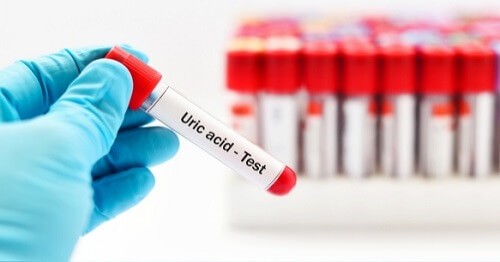 Acid Uric - ce inseamna un nivel crescut sau scazut