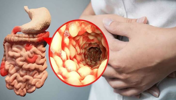 Boala Crohn – Simptome, cauze si tratament