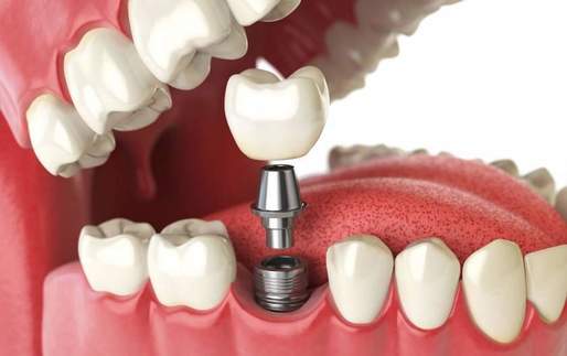 Principalele 10 avantaje ale unui implant dentar