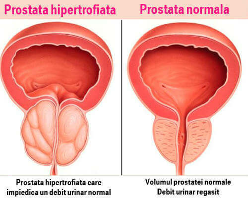 Prostatita acuta si cronica: simptome, cauze si tratament