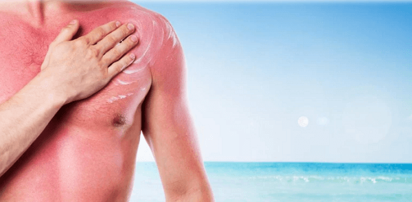 Arsurile solare: ce sunt? Metode rapide de tratament