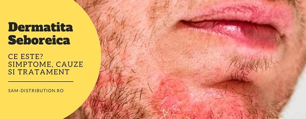 Dermatita seboreica: Ce este? Simptome, cauze si tratament