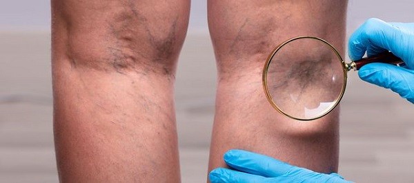 Tromboza: ce este? Cauze, Simptome si Tratament 
