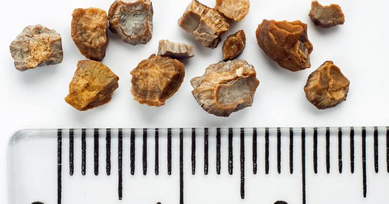 Pietre la Rinichi (Calculi Renali): Cauze, Simptome si Tratament