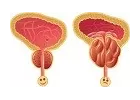 Prostata